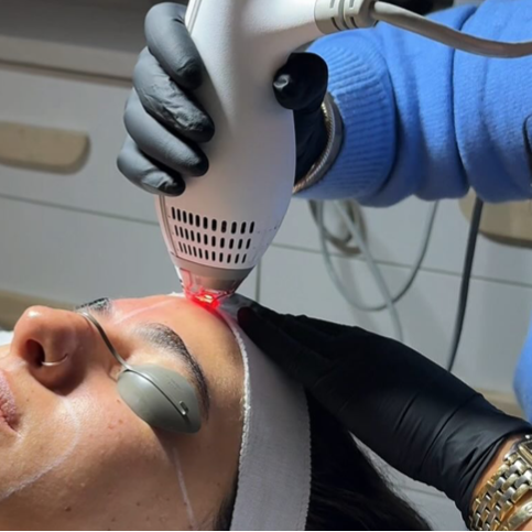 Person receiving a medical aesthetic services laser treatment on their face with medical equipment in the background.